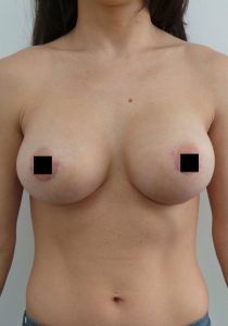 Breast Augmentation 1 - After