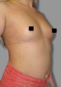 Breast Augmentation 3 - Before