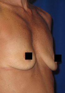 Breast Augmentation 2 - Before