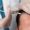 Hair Transplants