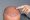 hair transplant