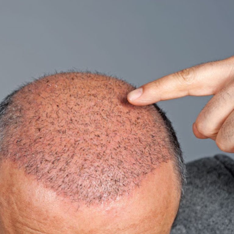 hair transplant